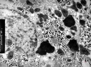 F,7m. | giant cell hepatitis F,7m. | giant cell hepatitis
